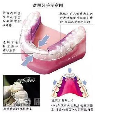 自锁托槽矫正是什么意思